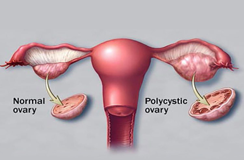 PCOS treatment in India
